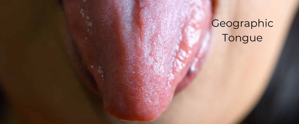 Geographic Tongue